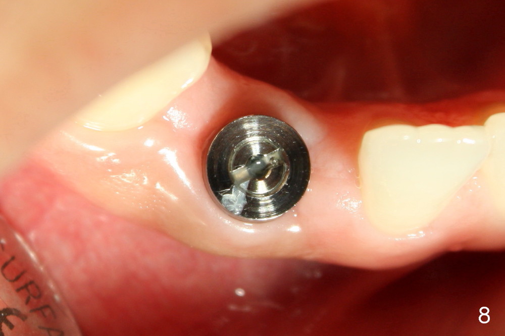 Immediate Implants for congenital missing teeth bone expansion and
